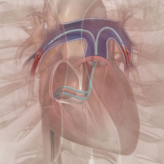 pulmonary artery technology image